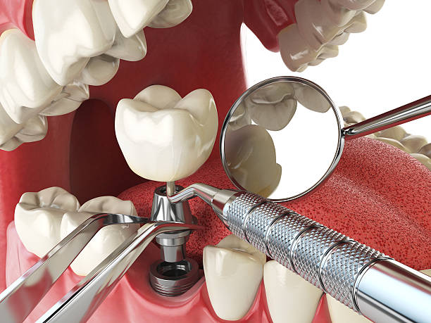 Best Emergency Root Canal Treatment in Berkeley, IL